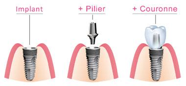 mutuelle dentaire
mutuelle dentiste