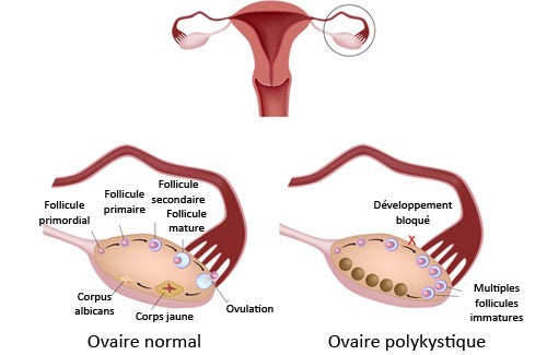 Le syndrome des ovaires polykystiques