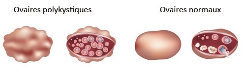Syndrome des ovaires polykystiques.