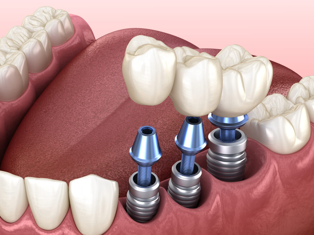 gouttière dents
bonne mutuelle dentaire